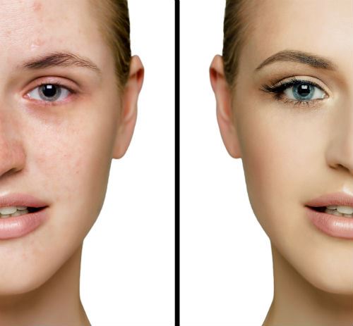 Are You a Good Candidate for Laser Skin Resurfacing? Photo