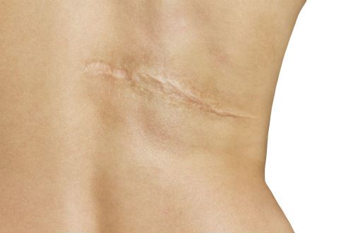 Can Your Scars be Removed by the Fractional CO2 Laser? Photo