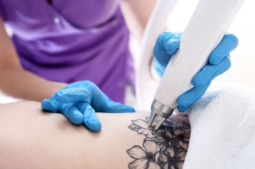 Common Myths about Laser Tattoo Removal Photo
