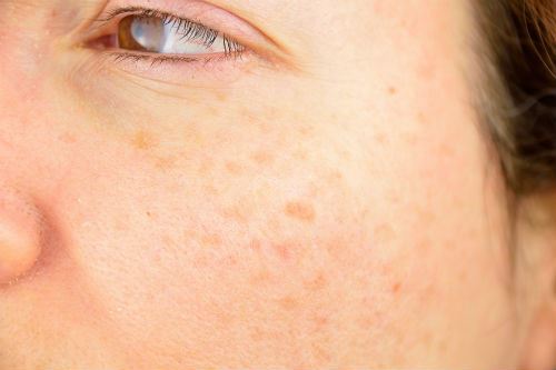 Everything You Need to Know Before Laser Skin Resurfacing Photo