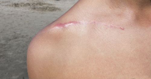 How Laser Scar Revision Can Help You Photo