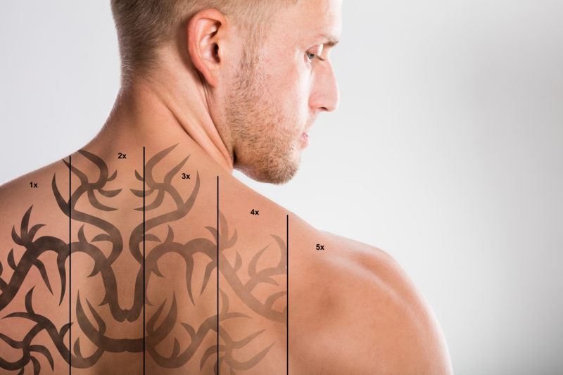 How to Take Care of Yourself Following Your Tattoo Removal Procedure Photo