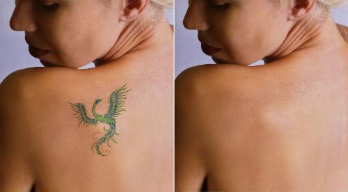 It’s Winter…Time to Remove Your Unwanted Tattoo Photo