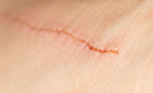 Options for Facial Scar Treatment Photo