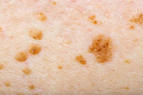 Prevention and Treatment Options for Skin Pigmentation Photo