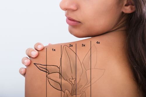 Realistic Expectations After Each Laser Tattoo Removal Appointment Photo