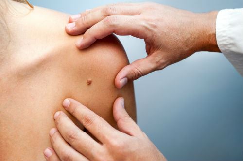 Side Effects of Pigmented Lesion Removal Photo