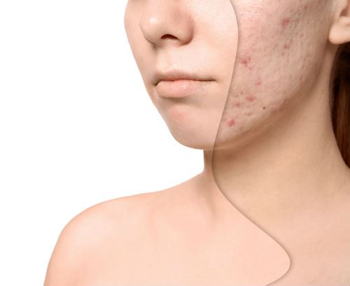 Step-by-Step Timeline for Laser Acne Scar Revision Photo