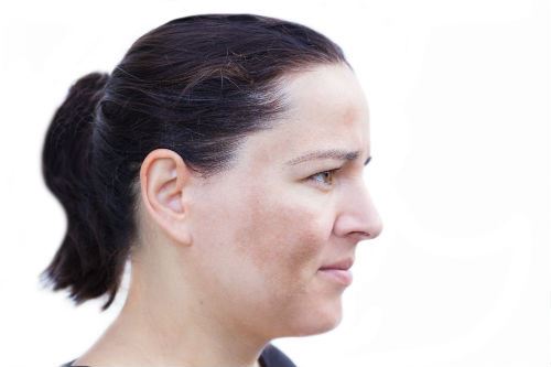 The Advantages of a Fractional CO2 Laser Photo