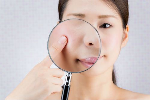 The Benefits of Acne Scar Treatments Photo