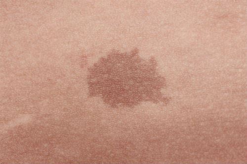 The Benefits of Pigmented Lesion Removal Photo