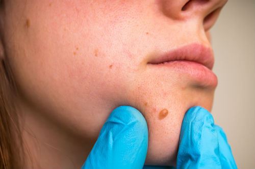 The Cost for Red Mole Removal Photo