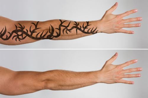 The Laser You Want When Removing Your Tattoo Photo