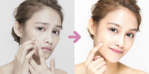 The Most Common Types of Acne and How to Deal With Them Photo