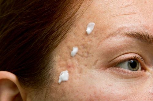 Topical Acne Products Work Slower Than You Think Photo