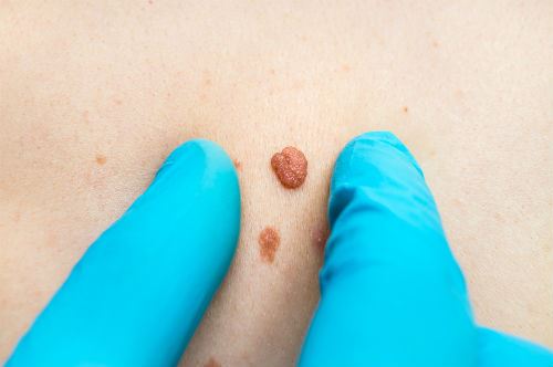 What Are Your Options for Cherry Angioma Removal? Photo