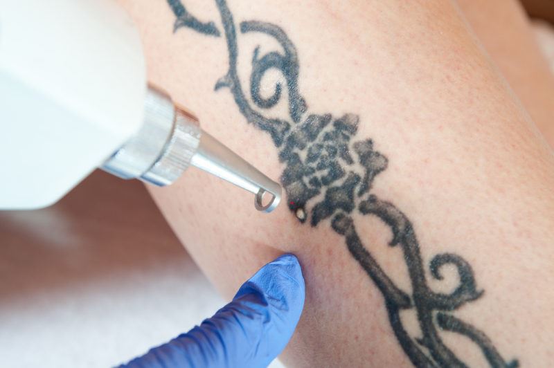 What Is PicoSure? Photo