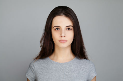 When is Professional Acne Revision Your Best Option? Photo