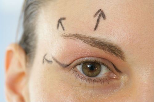 Who Should Consider Eyelid Surgery? Photo